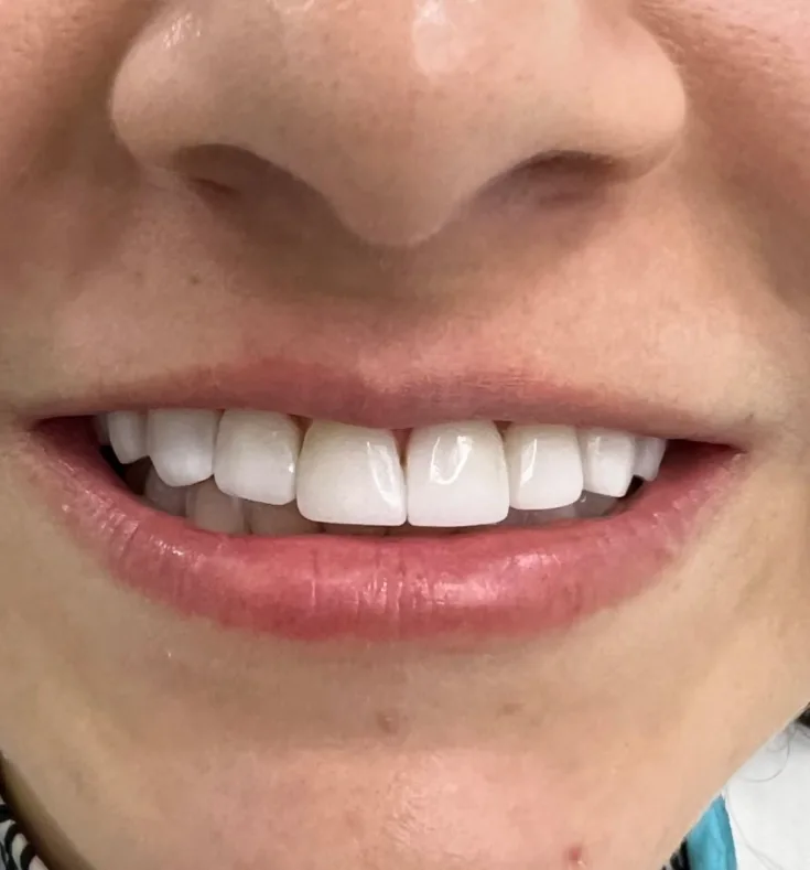 Antes del diseño de sonrisa