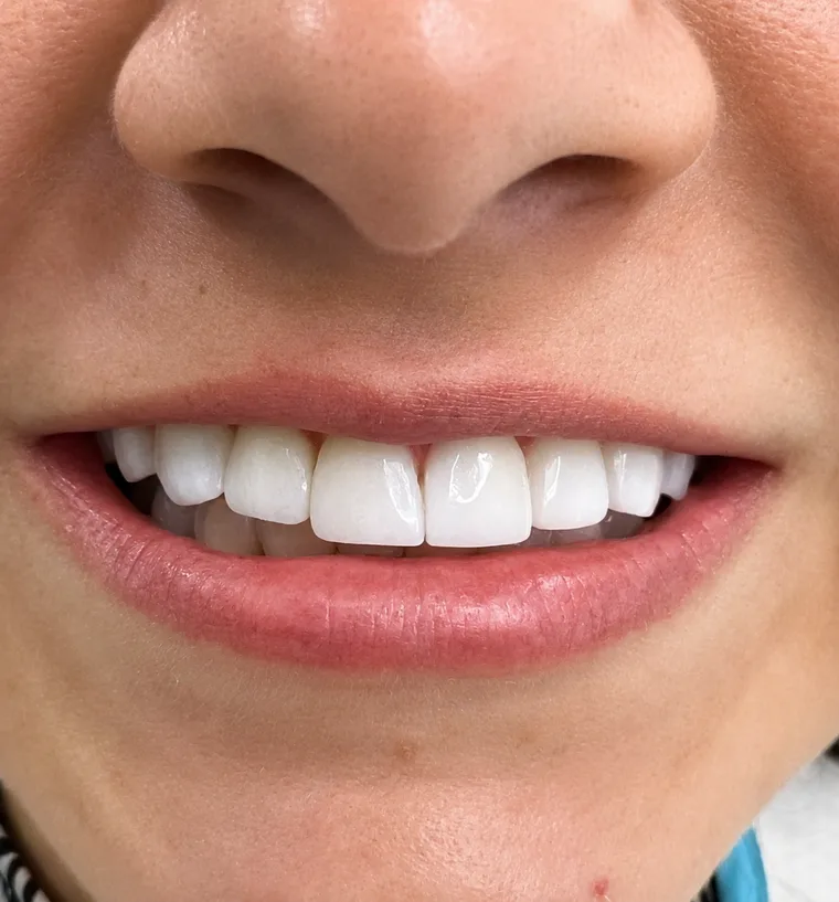 Después del diseño de sonrisa
